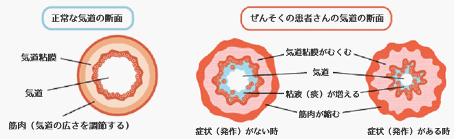 ぜんそく 気管支喘息 診療案内 いりたに内科クリニック